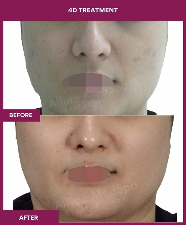 4d-skin-whitening-treatment-before-after-results-mumbai-india-patient06-front