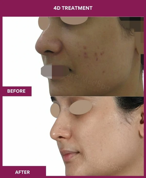 4d-skin-whitening-treatment-before-after-results-mumbai-india-patient06-side-left