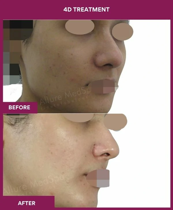 4d-skin-whitening-treatment-before-after-results-mumbai-india-patient06-side-right