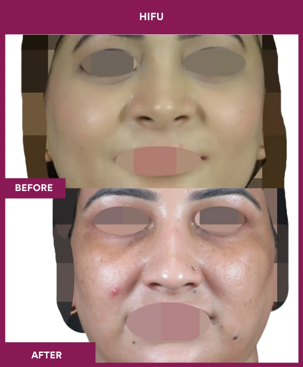 HIFU-treatment-before-after-results-mumbai-patient01-front
