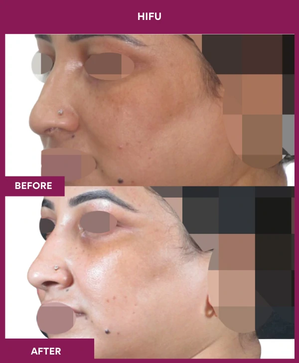 HIFU-treatment-before-after-results-mumbai-patient01-side-left