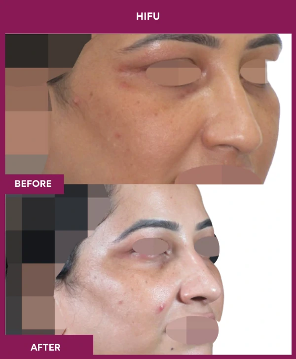 HIFU-treatment-before-after-results-mumbai-patient01-side-right