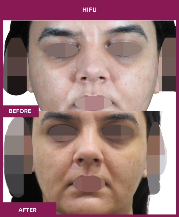 HIFU-treatment-before-after-results-mumbai-patient02-front