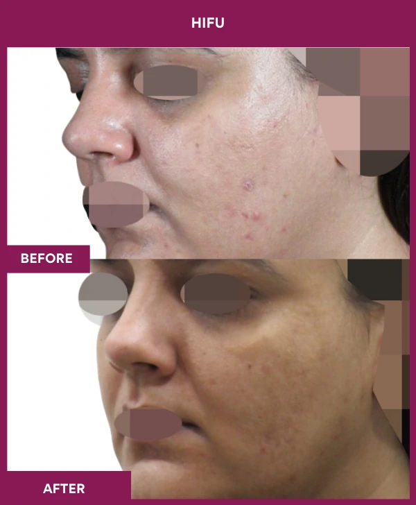 HIFU-treatment-before-after-results-mumbai-patient02-side-left