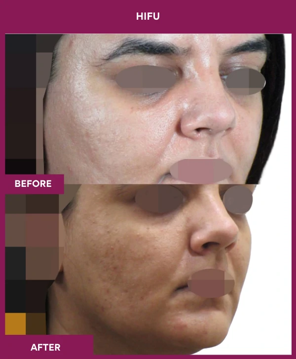 HIFU-treatment-before-after-results-mumbai-patient02-side-right