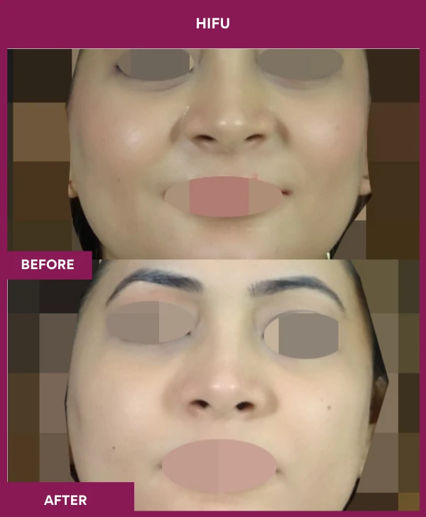HIFU-treatment-before-after-results-mumbai-patient03-front