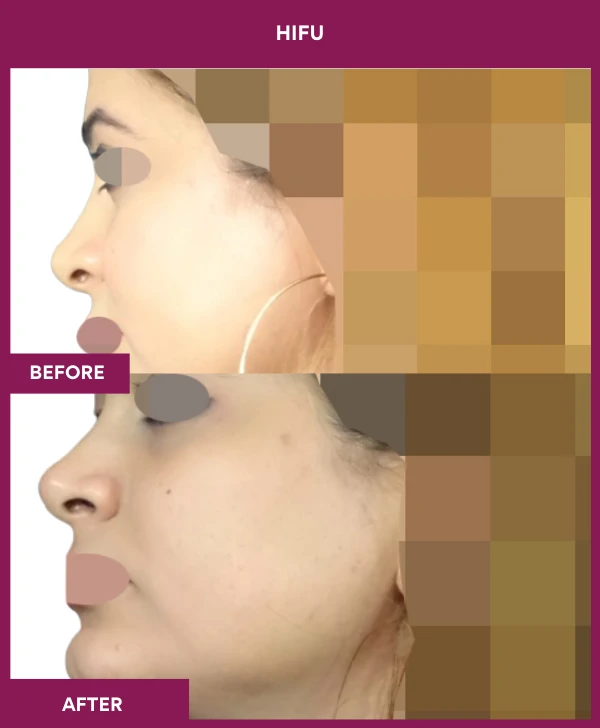 HIFU-treatment-before-after-results-mumbai-patient03-side-left