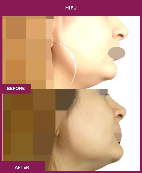 HIFU-treatment-before-after-results-mumbai-patient03-side-right