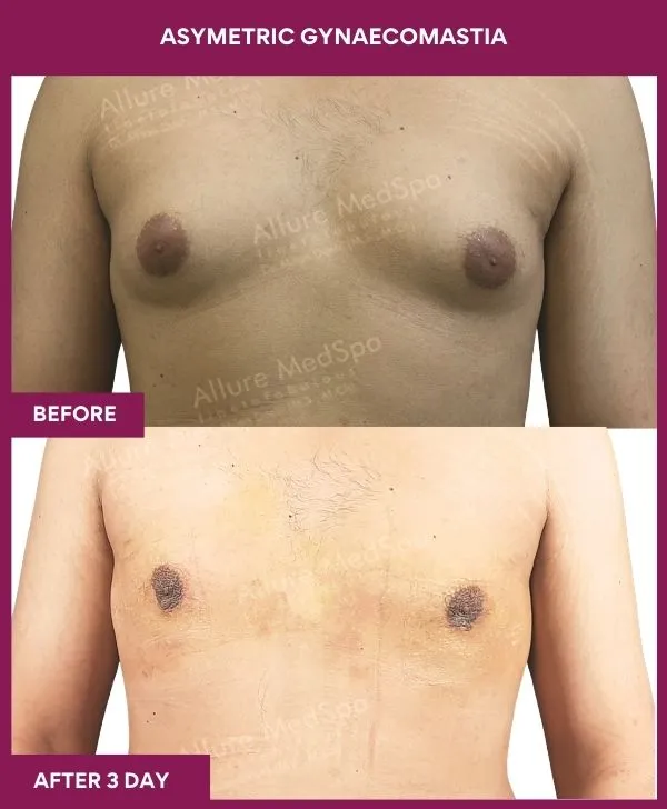 asymetric-gynecomastia-surgery-before-after-results-mumbai-india-patient01-front