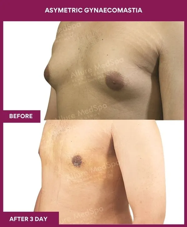 asymetric-gynecomastia-surgery-before-after-results-mumbai-patient01-side-left