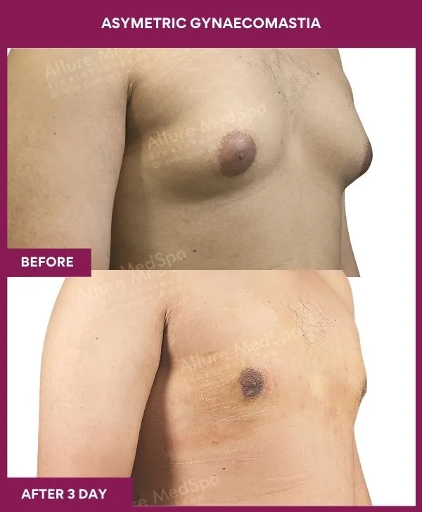 asymetric-gynecomastia-surgery-before-after-results-mumbai-india-patient01-side-right