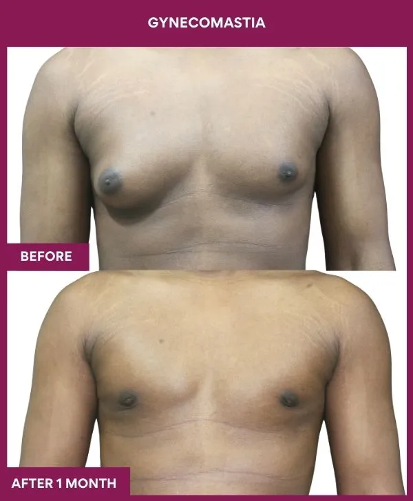 asymetric-gynecomastia-surgery-before-after-results-mumbai-india-patient02-front