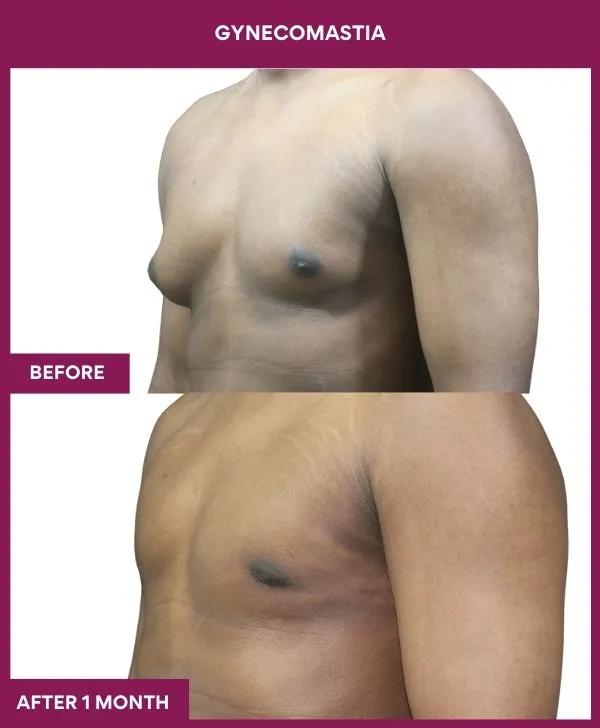 asymetric-gynecomastia-surgery-before-after-results-mumbai-india-patient02-side-left