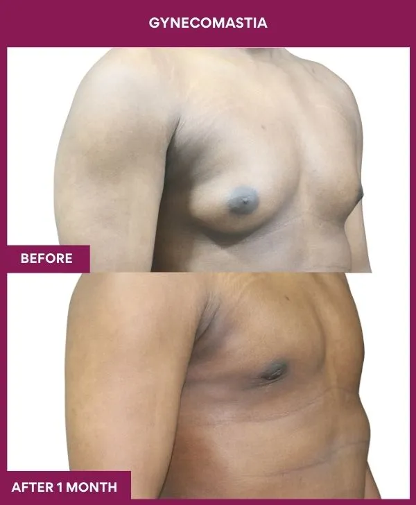 asymetric-gynecomastia-surgery-before-after-results-mumbai-india-patient02-side-right