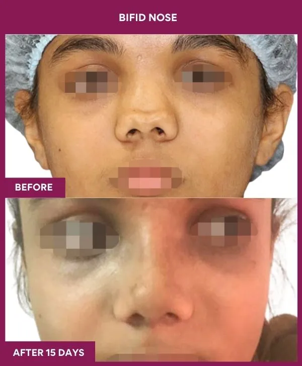 bifid-nose-rhinoplasty-before-after-results-mumbai-india-patient01-front