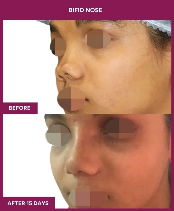 bifid-nose-rhinoplasty-before-after-results-mumbai-india-patient01-side-left