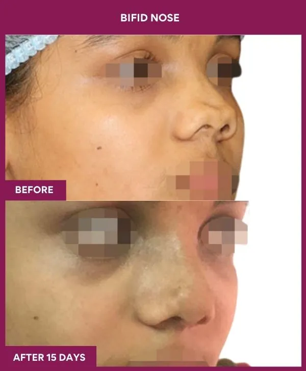 bifid-nose-rhinoplasty-before-after-results-mumbai-india-patient01-side-right