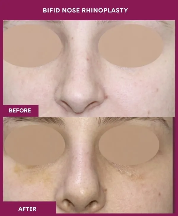 bifid-nose-rhinoplasty-surgery-before-after-results-mumbai-india-patient01-front