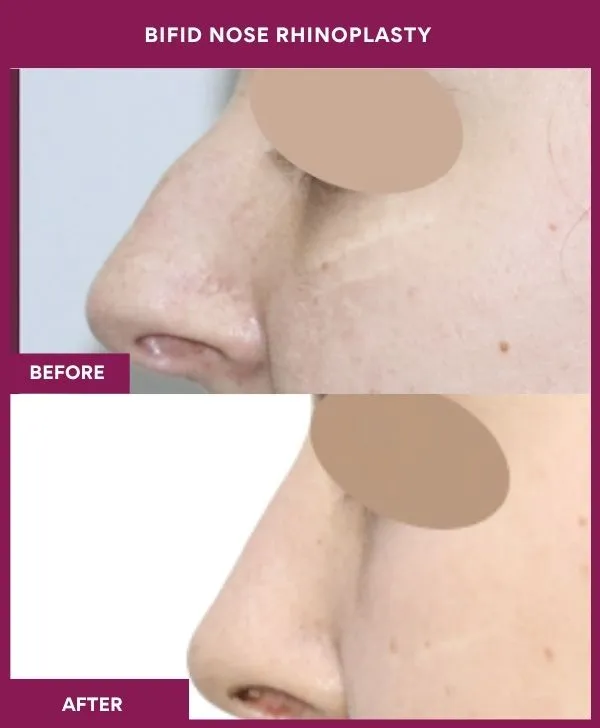 bifid-nose-rhinoplasty-surgery-before-after-results-mumbai-india-patient01-side-left