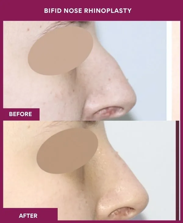 bifid-nose-rhinoplasty-surgery-before-after-results-mumbai-india-patient01-side-right