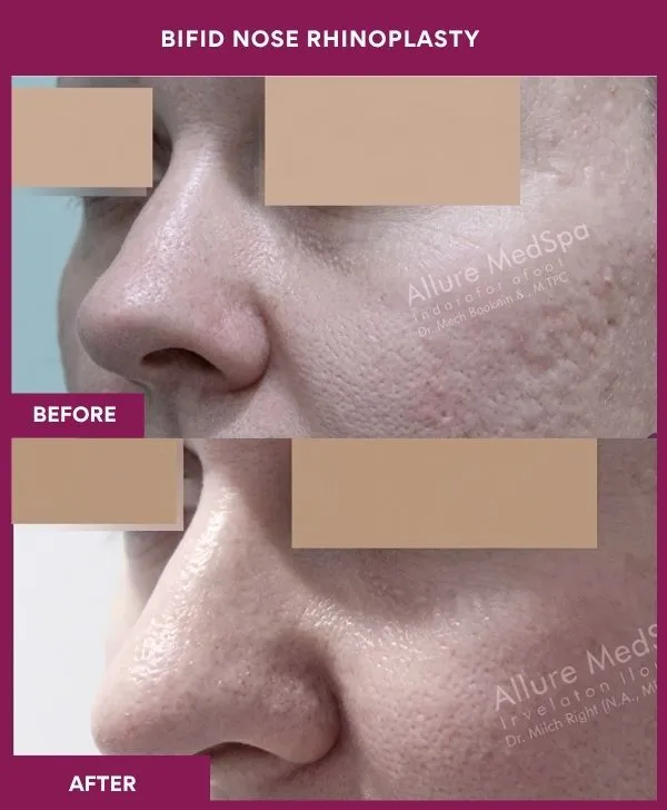 bifid-nose-rhinoplasty-surgery-before-after-results-mumbai-india-patient02-side-left
