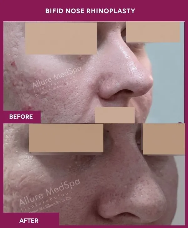 bifid-nose-rhinoplasty-surgery-before-after-results-mumbai-india-patient02-side-right