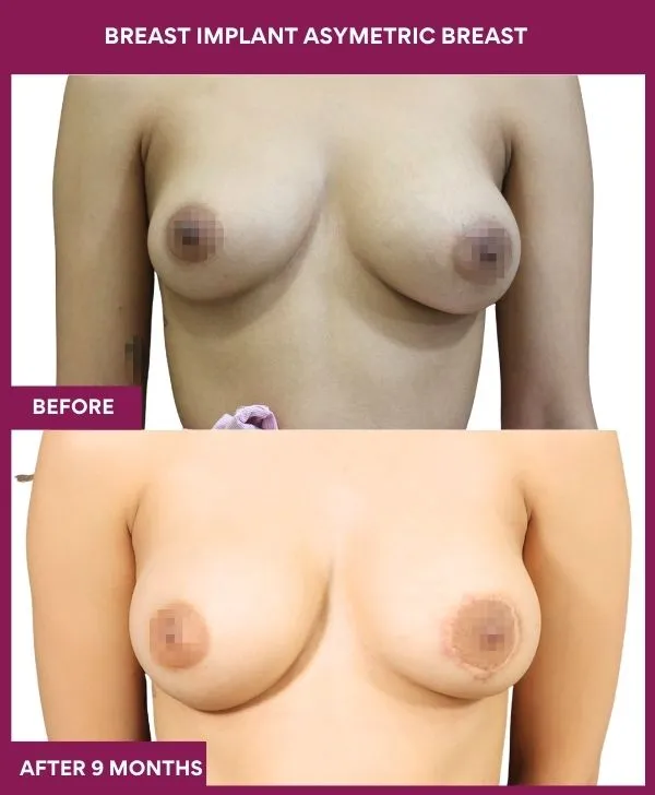 breast-asymmetry-reduction-before-after-results-mumbai-india-patient01-front