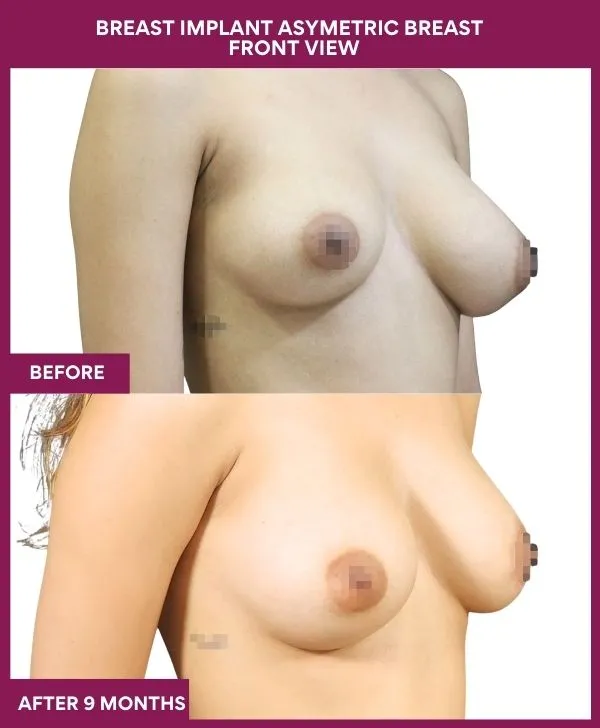 breast-asymmetry-reduction-before-after-results-mumbai-india-patient01-side-right