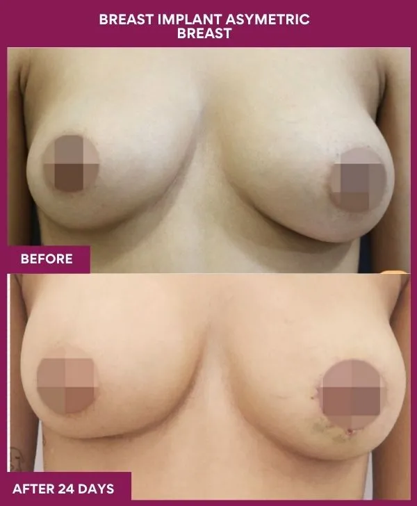 breast-asymmetry-reduction-before-after-results-mumbai-india-patient02-front