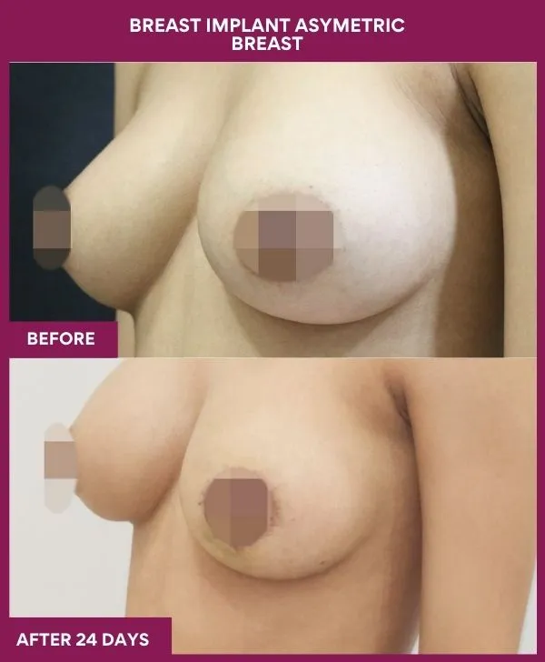 breast-asymmetry-reduction-before-after-results-mumbai-india-patient02-side-left