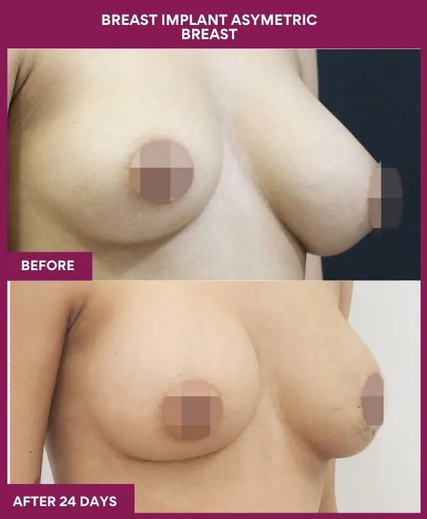 breast-asymmetry-reduction-before-after-results-mumbai-india-patient02-side-right