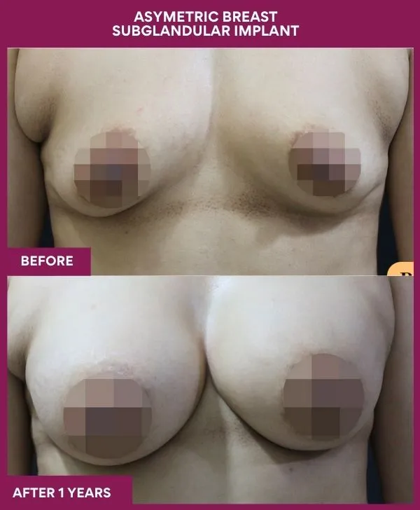 breast-asymmetry-reduction-before-after-results-mumbai-india-patient03-front