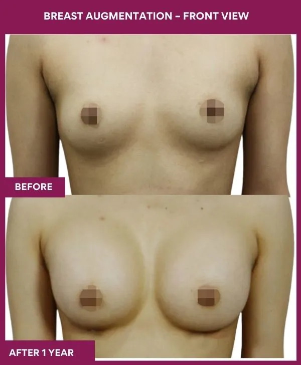 breast-augmentation-before-after-results-mumbai-patient04-front