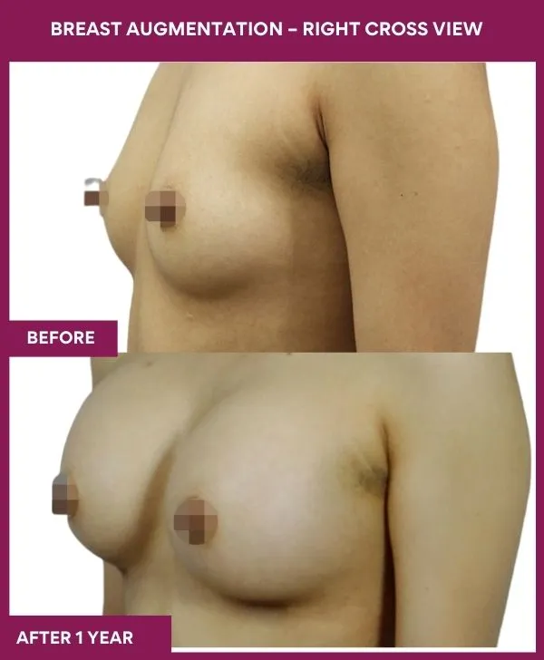breast-augmentation-before-after-results-mumbai-patient04-side-left