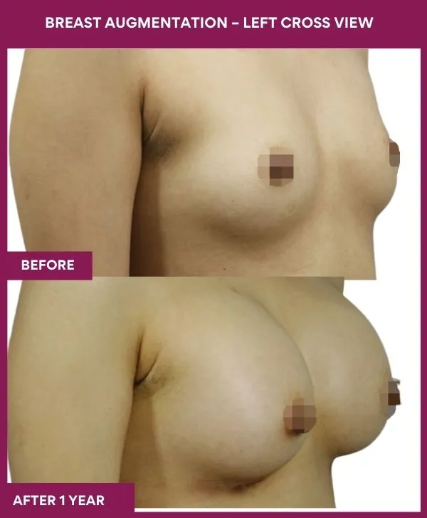breast-augmentation-before-after-results-mumbai-patient04-side-right