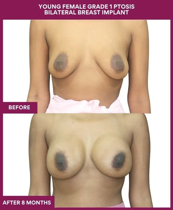breast-augmentation-before-after-results-mumbai-patient06-front