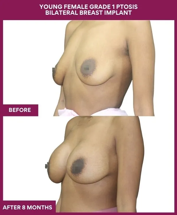 breast-augmentation-before-after-results-mumbai-patient06-side-left