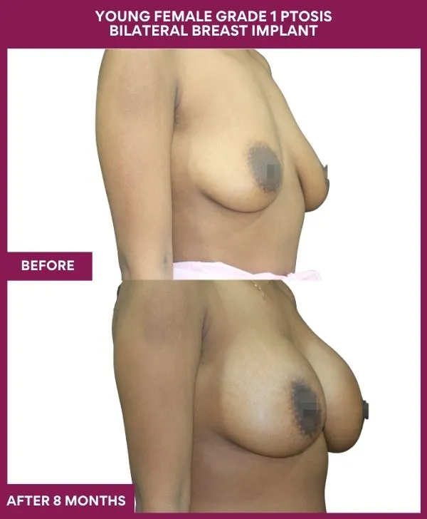 breast-augmentation-before-after-results-mumbai-patient06-side-right