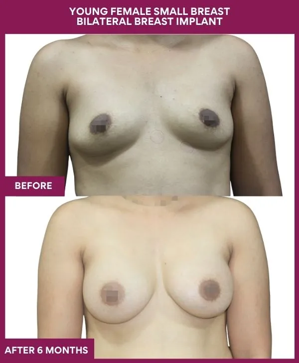 breast-augmentation-before-after-results-mumbai-patient07-front