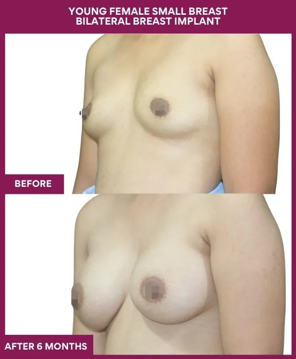 breast-augmentation-before-after-results-mumbai-patient07-side-left