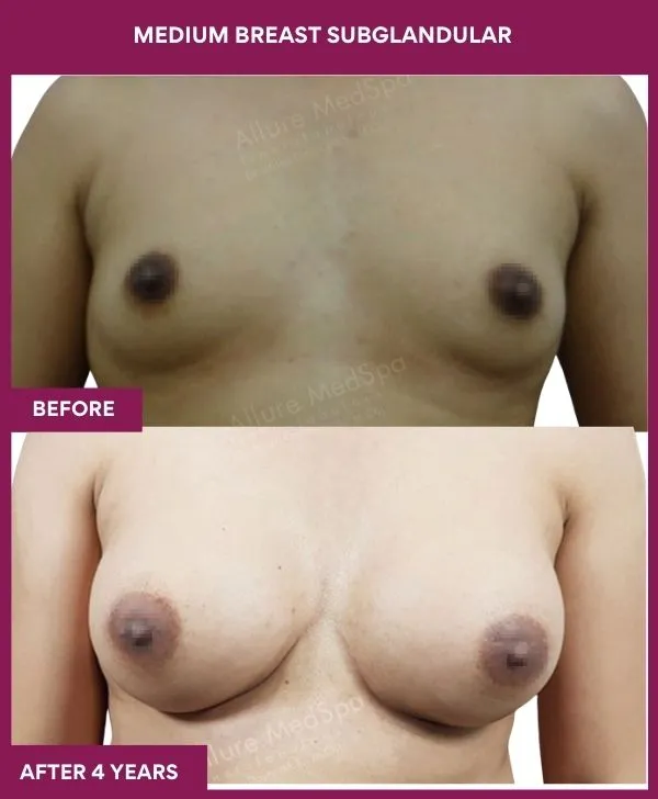 breast-augmentation-subglandular-before-after-results-mumbai-patient03-front