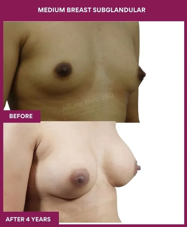 breast-augmentation-subglandular-before-after-results-mumbai-patient03-side-right