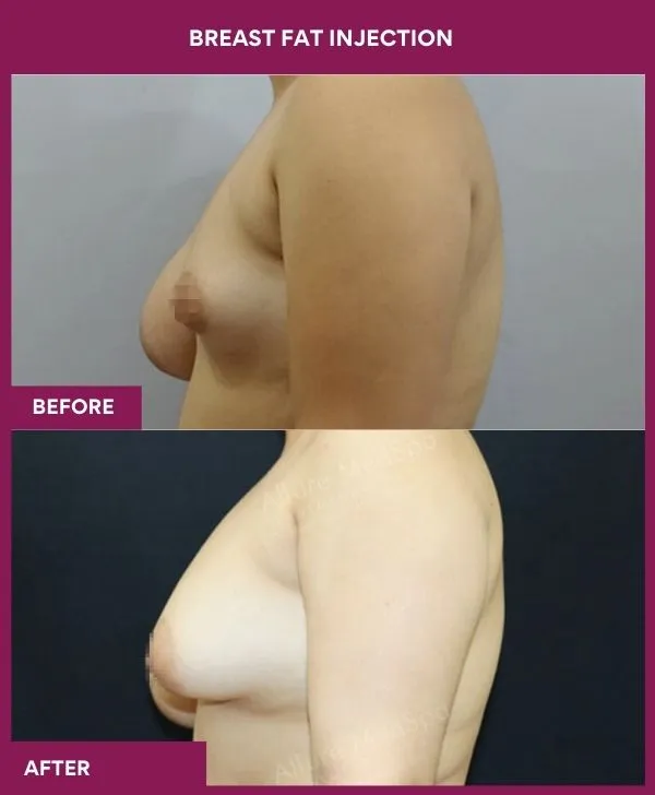 breast-fat-injection-before-after-results-mumbai-india-patient01-side-left