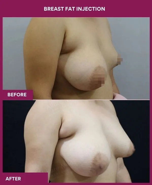 breast-fat-injection-before-after-results-mumbai-india-patient01-side-right