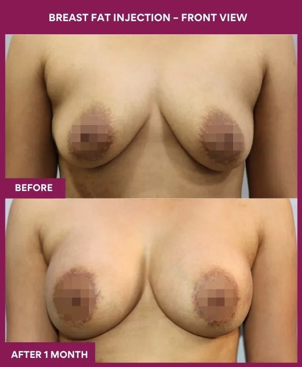 breast-fat-injection-before-after-results-mumbai-india-patient02-front