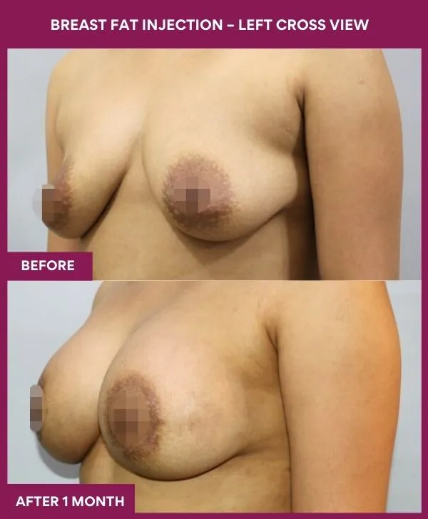 breast-fat-injection-before-after-results-mumbai-india-patient02-side-left