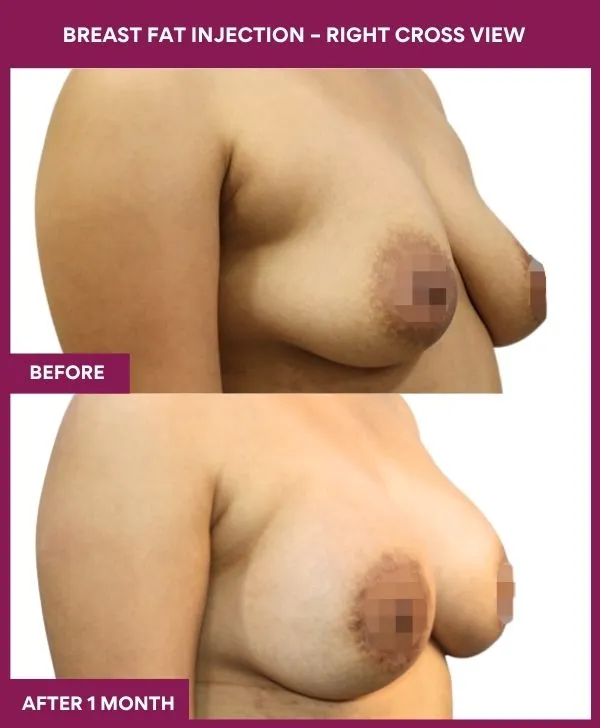 breast-fat-injection-before-after-results-mumbai-india-patient02-side-right