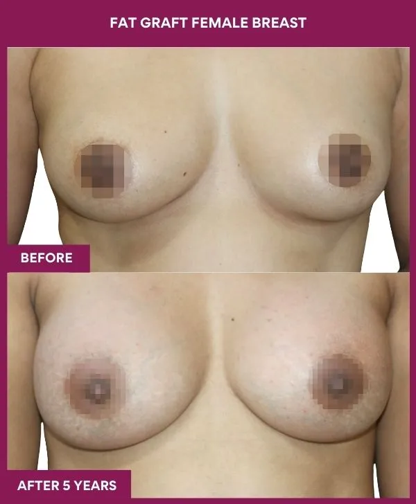 breast-fat-transfer-before-after-results-mumbai-india-patient03-front