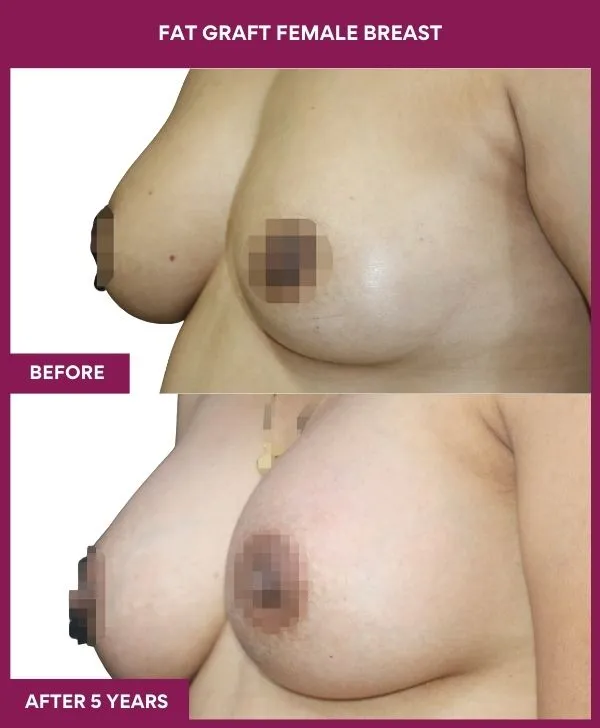 breast-fat-transfer-before-after-results-mumbai-india-patient03-side-left