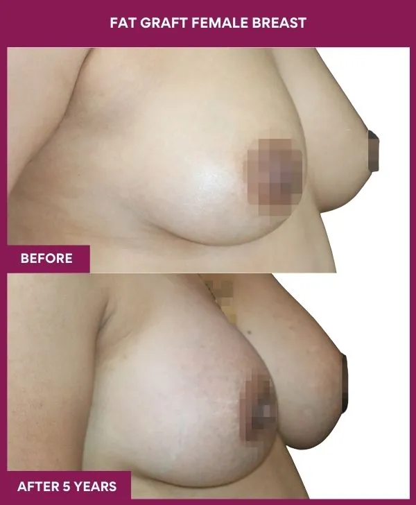 breast-fat-transfer-before-after-results-mumbai-india-patient03-side-right